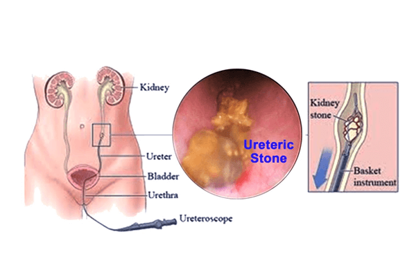 Retrograde Intrarenal Surgery (RIRS)